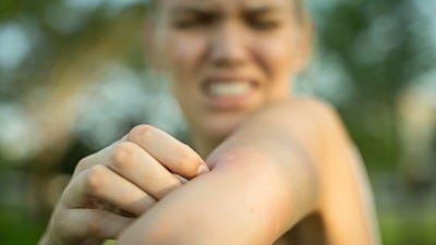 The Dos and Don’ts of Mosquito Bites