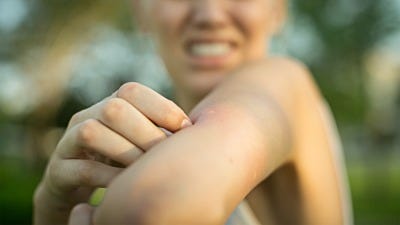 Why Do Mosquito Bites Itch?